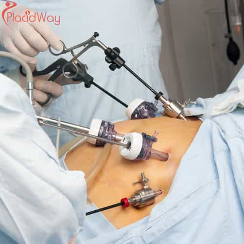 Gastric Bypass Surgery in Mexico: A Cost-Effective Weight Loss Solution for Canadians